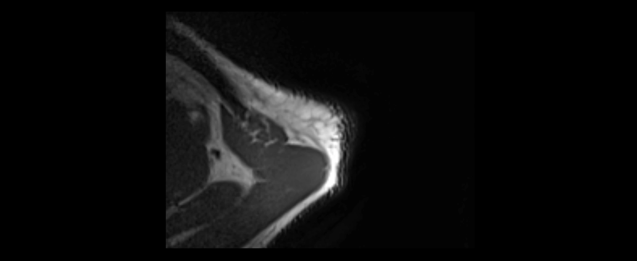shoulder ligaments axial 3d 3t mri image-img-00005-00009.webp